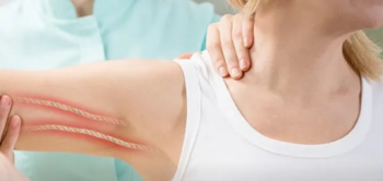 腋网综合征 | 乳腺癌术后，手臂里怎么有根“绳子”？